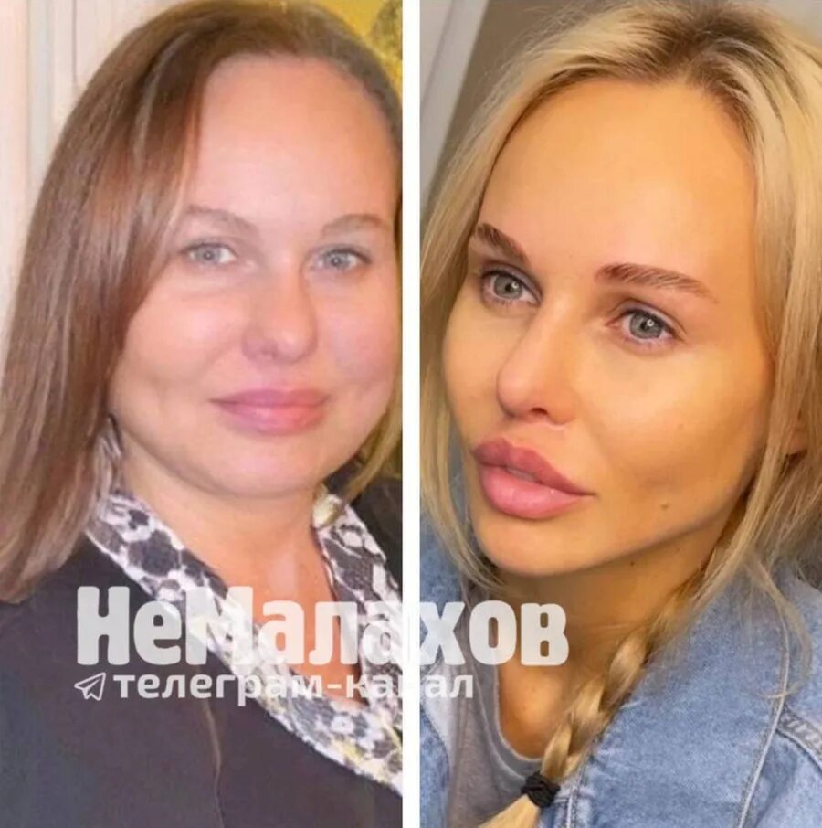 Мамаева до и после пластики фото. Мамаева до и после пластики фото