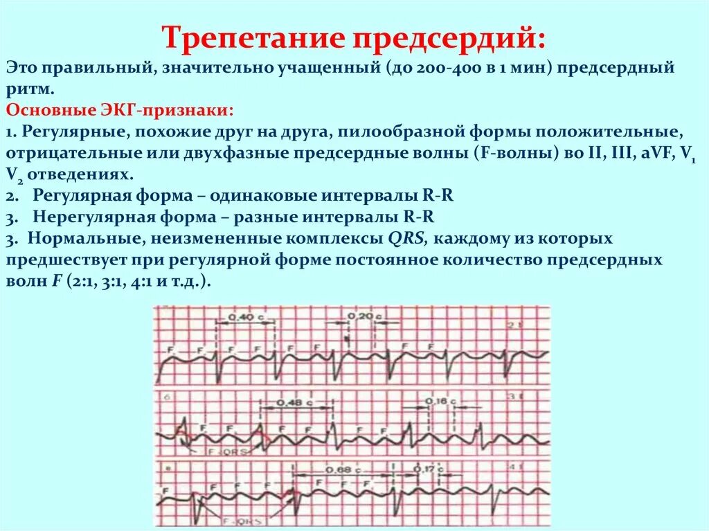 Трепетание предсердий 4 к 1 на ЭКГ. Трепетание предсердий 2 к 1 на ЭКГ. Трепетание предсердий 1 к 1 на ЭКГ. Атипичное трепетание предсердий на ЭКГ. Формы трепетания предсердий