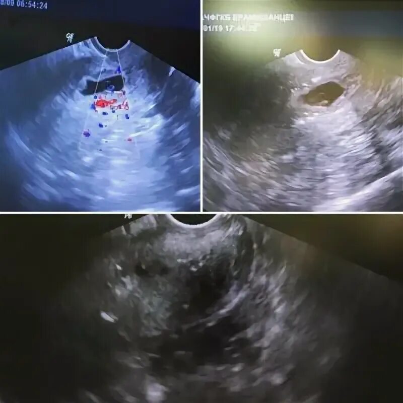 Внематочная беременность 5-6 недель УЗИ. Внематочная на УЗИ 5 недель. Снимок внематочной беременности.