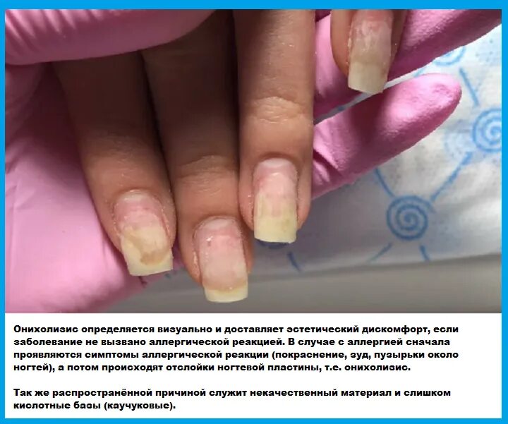 Как лечить ногти после маникюра