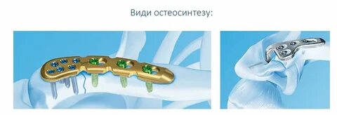 Импланты для остеосинтеза