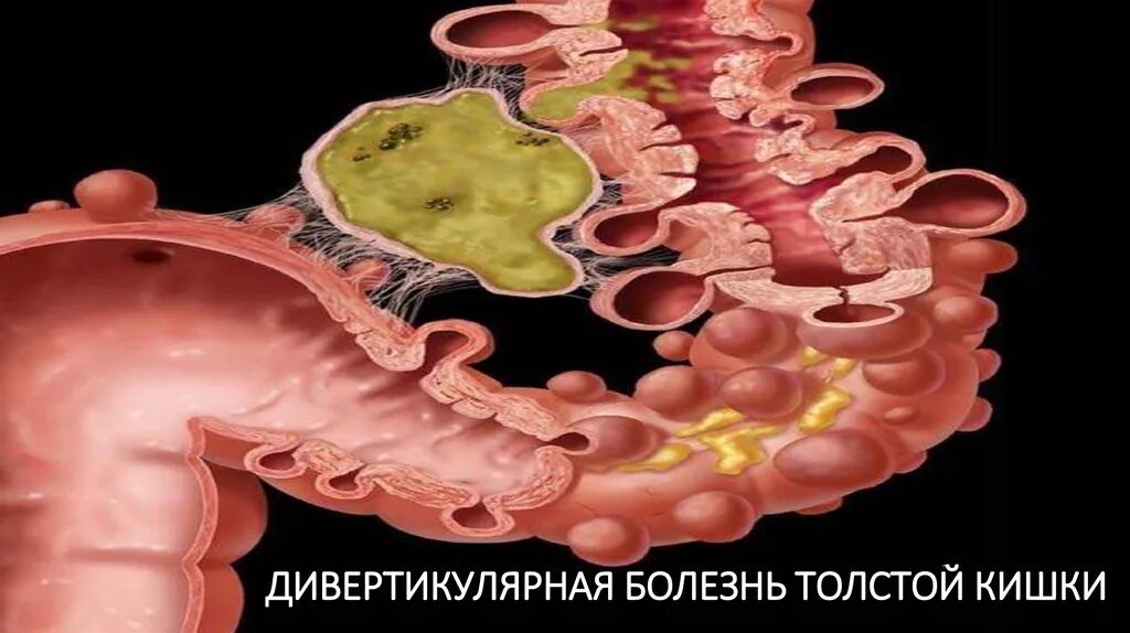 Дивертикул меккеля у детей. Хронические осложнения дивертикулярной болезни. Дивертикулёз кишечника. Классификация дивертикулярной болезни кишечника. Дивертикулярная болезнь толстой кишки патогенез.