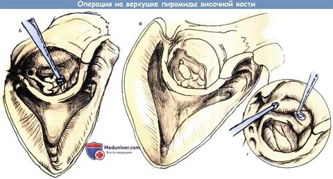 Операция височных костей