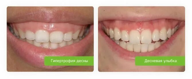Подрезать зубы