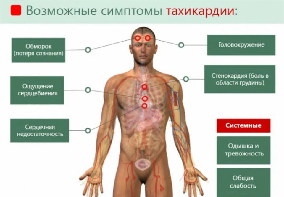 Сильный пульс что делать. Тахикардия симптомы. Тахикардические проявления. Симптомы при тахикардии. Симптомы учащенного сердцебиения.