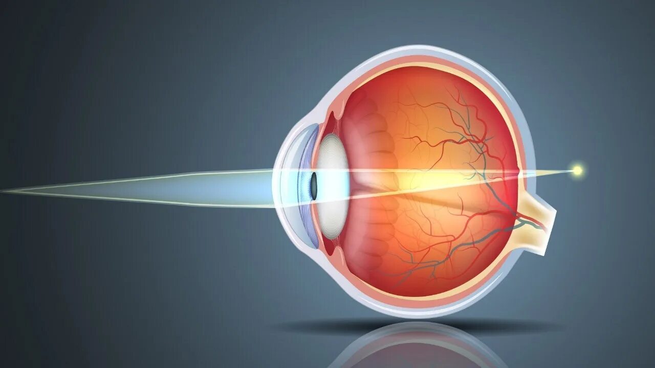 Миопия астигматизм глаз. Роговица хрусталик сетчатка. Строение глаза роговица хрусталик. Рефракция миопия. Строение глаза близорукого человека.