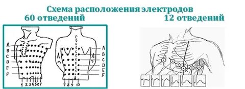 Перепутанные электроды