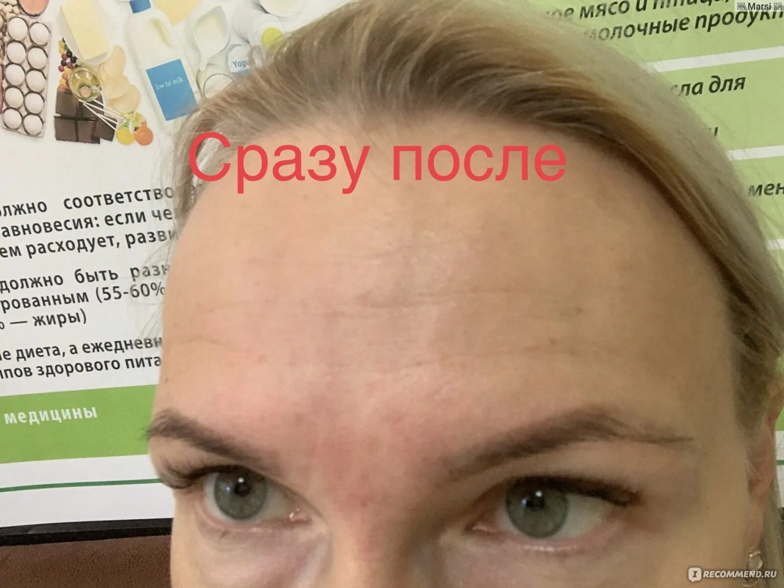 После ботокса может болеть голова. Ботулотоксин брови мефистофеля. ботокс брови мефистофеля. брови мефистофеля после ботокса. ботокс бровей до и после.
