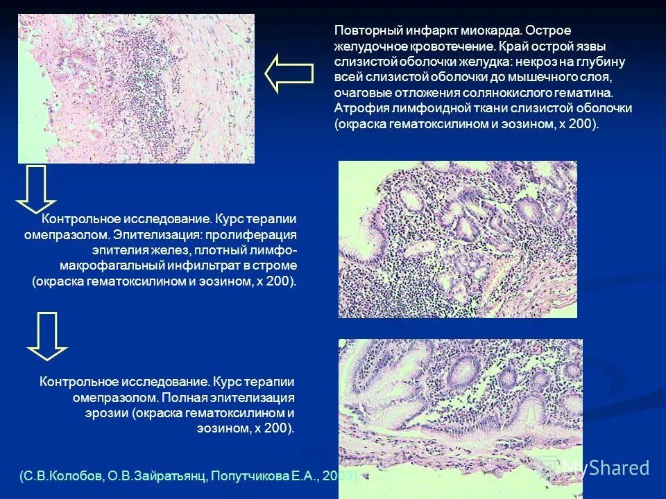 Рецидивирующий инфаркт миокарда. Повторный и рецидивирующий инфаркт миокарда. Первичный рецидивирующий и повторный инфаркт. Некроз ткани инфаркт миокарда. Биоптат слизистой оболочки