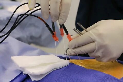 Сколько длится операция рча