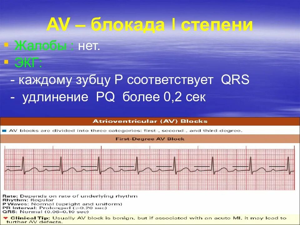 Зубцы р после qrs. Av блокада у детей. блокада зубца r экг. удлинение qrs. удлинение зубца р.