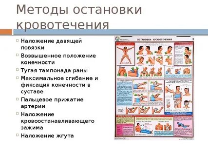 Наложение жгута пальцевое прижатие артерий