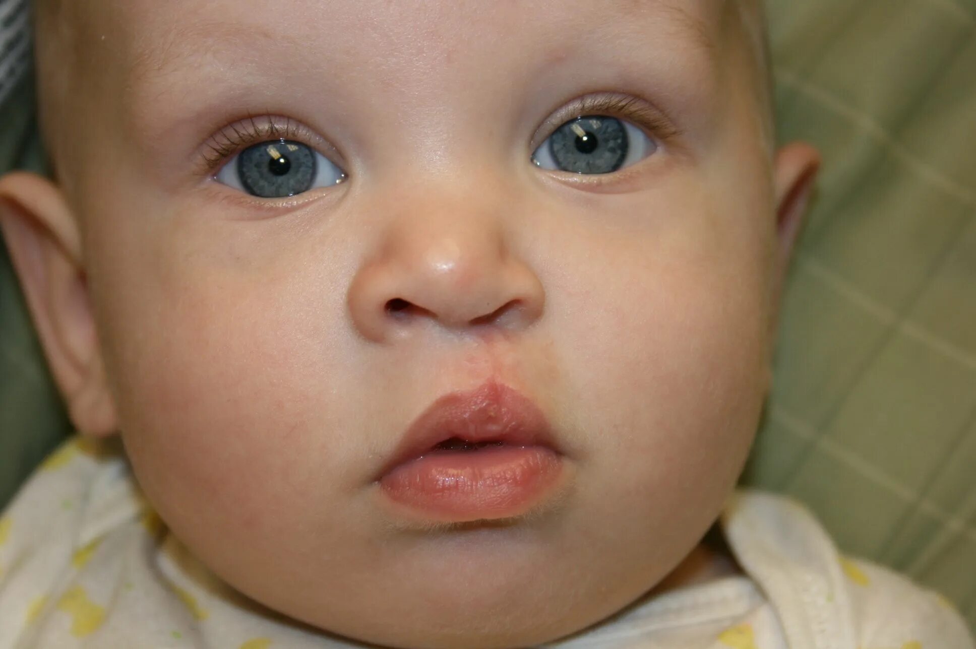 My little man TJ born 12/24/11 with a unilateral cleft lip and palate. Before an