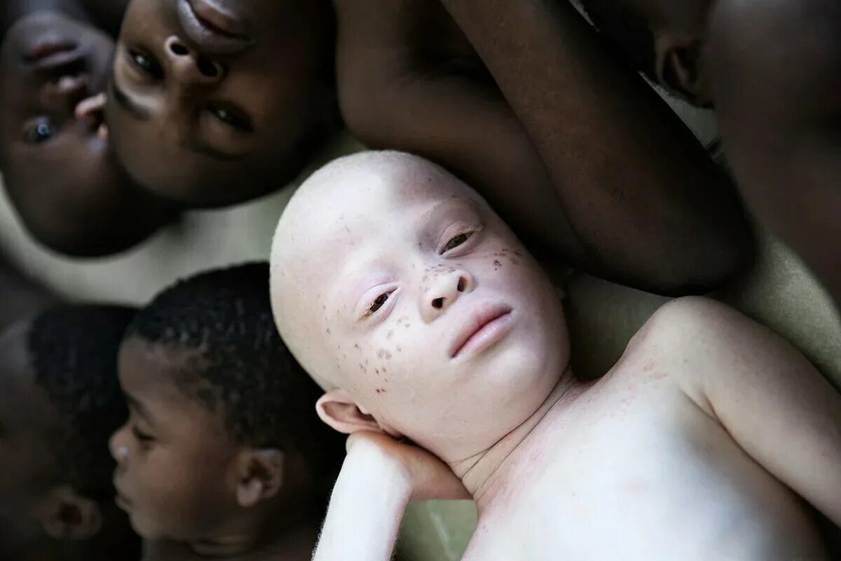 Страдающий альбинизмом. Альбинос негроидной расы.
