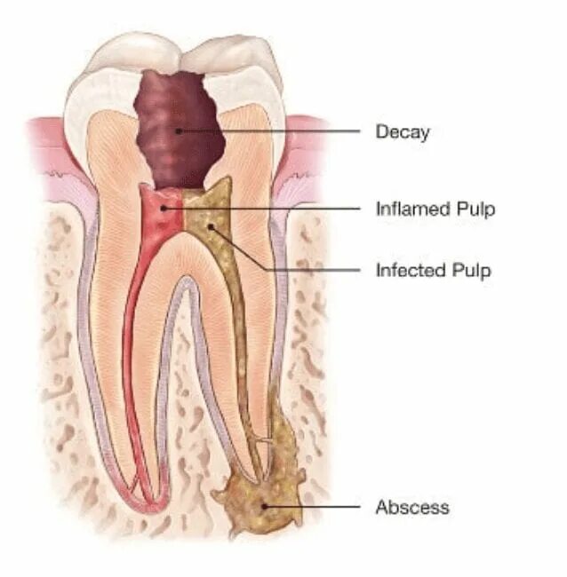 Root canal. Строение зуба кариес пульпит.
