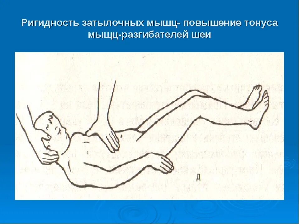 Симптом ригидности затылочных. Менингит ригидность затылочных мышц. Ригидность мышц затылка.