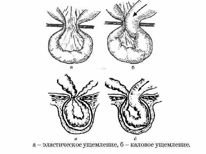 Ответы ущемленная грыжа. Эластическое ущемление грыжи. Антеградное ущемление грыжи. Каловая ущемленная грыжа. Механизм калового ущемления грыжи.