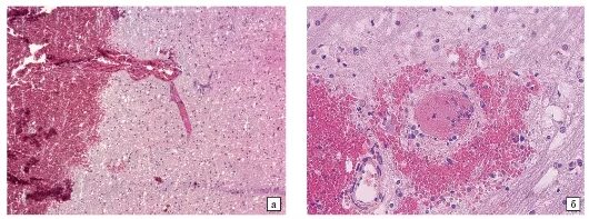 Микропрепарат головного мозга. Гематома головного мозга микропрепарат. Геморрагический инфаркт головного мозга микропрепарат. Кровоизлияние в головной мозг микропрепарат. Диапедезные кровоизлияния в мозг микропрепарат.
