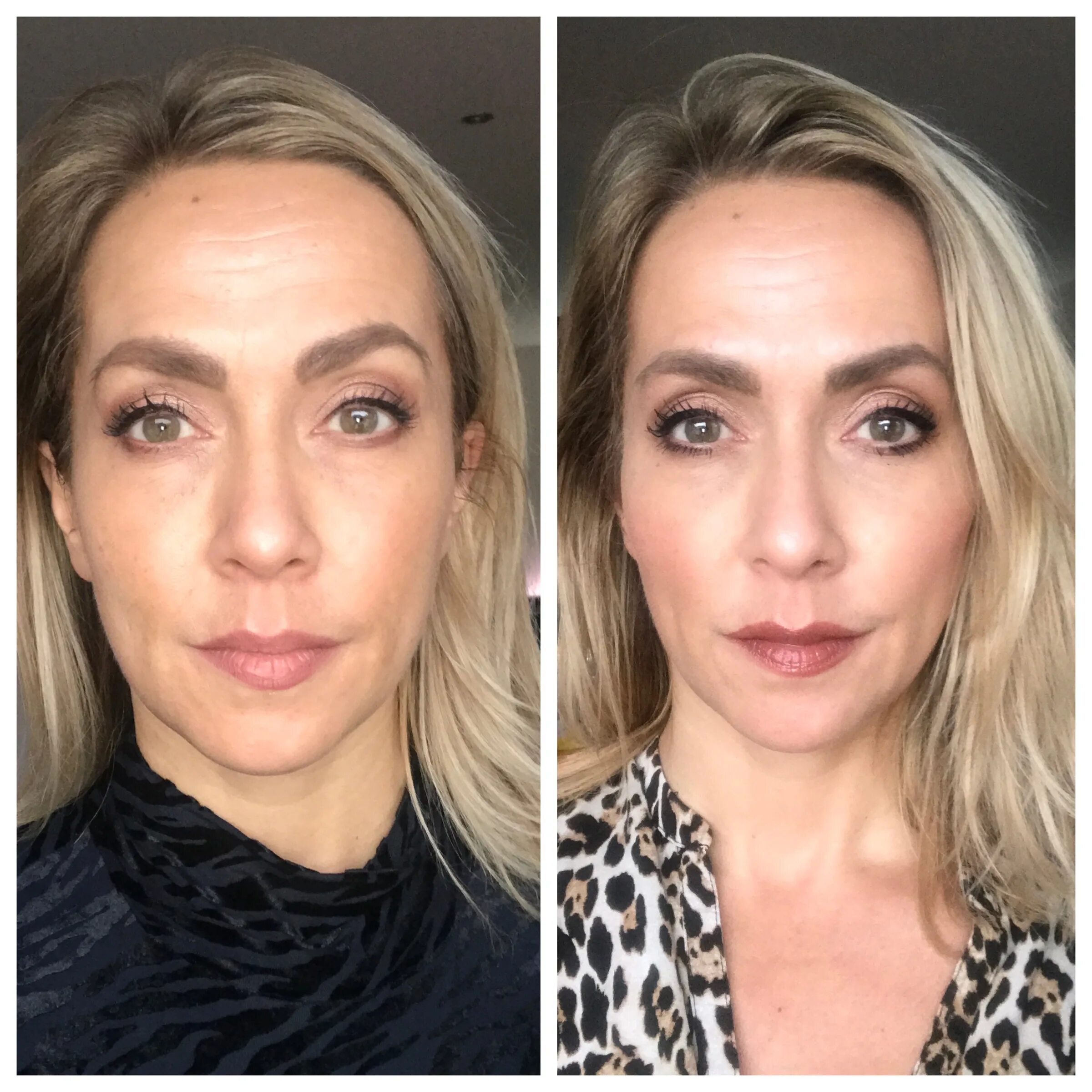 Brow lifting. Броулифтинг. Лифтинг бровей. Подтяжка бровей броулифтинг. Броулифтинг до и после.