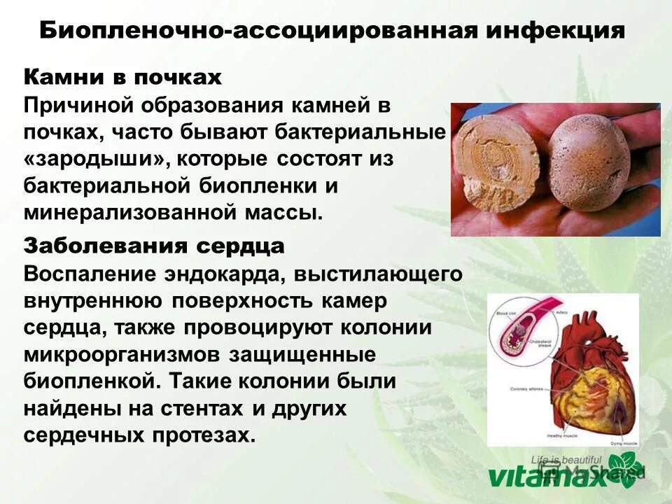 Мочекаменная болезнь (уролитиаз). Как выглядят камни в почках когда выходят. Почему камни в почках причины. Локализация камней в почках. Камни в посках симптом.