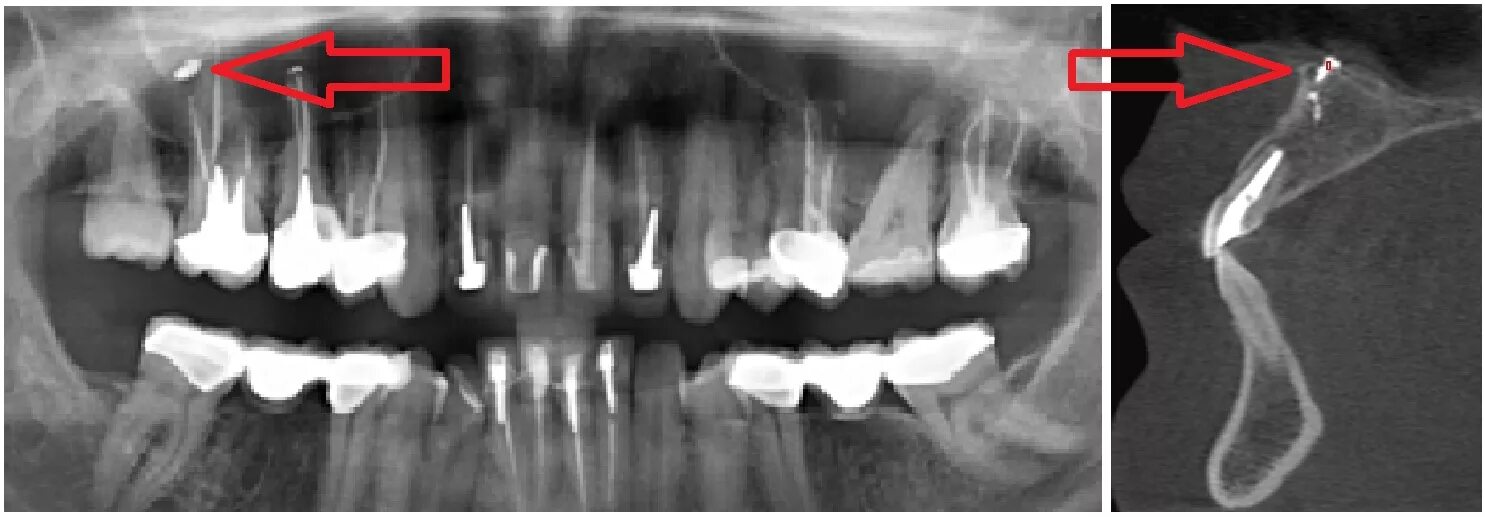 Зуб дает температуру. Периодонтит радиовизиография. Штифт стоматологический рентген. Тройничный нерв на рентгене зуба.