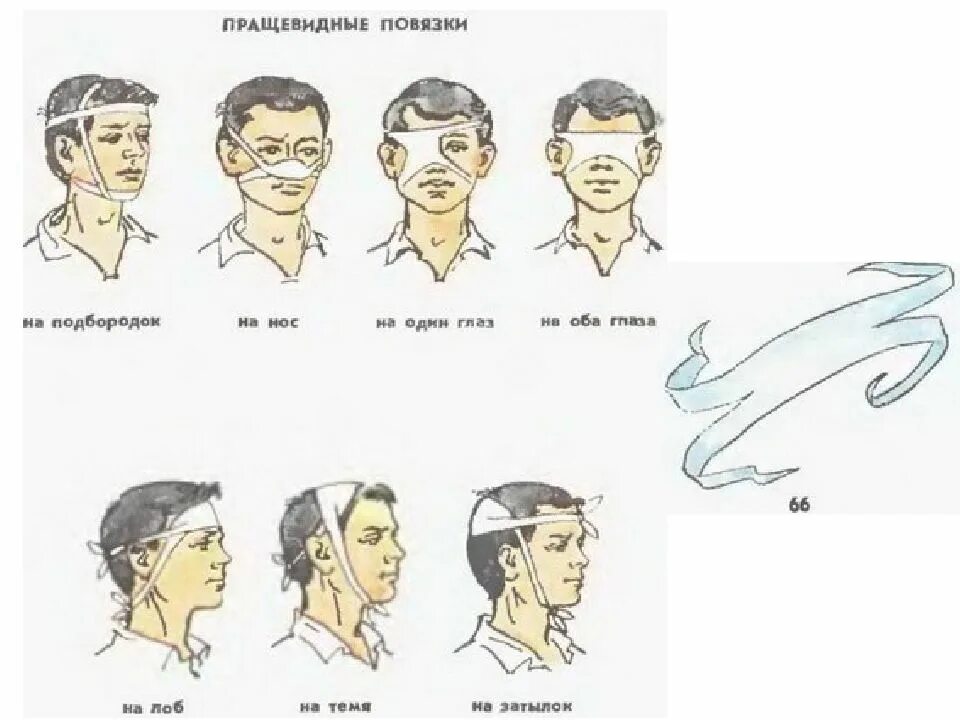 Техника наложения пращевидной повязки. Пращевидная повязка алгоритм. Пращевидная повязка на нос алгоритм наложения повязки. Схема наложения пращевидной повязки.