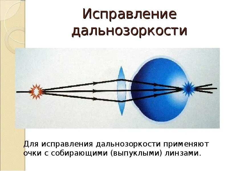 Дальнозоркость линзы двояковыпуклые. Дефекты зрения близорукость. Дефекты зрения дальнозоркость. Близорукость и дальнозоркость. Дальнозоркость физика.