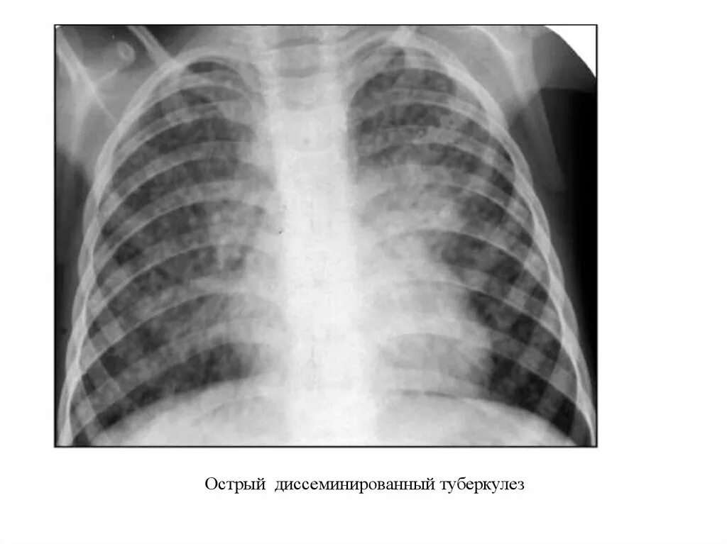 Острый диссеминированный туберкулез. Диссеминированный туберкулез рентген. Острый диссеминированный туберкулез рентген. Милиарный диссеминированный туберкулез. Острый диссеминированный туберкулез легких рентген.