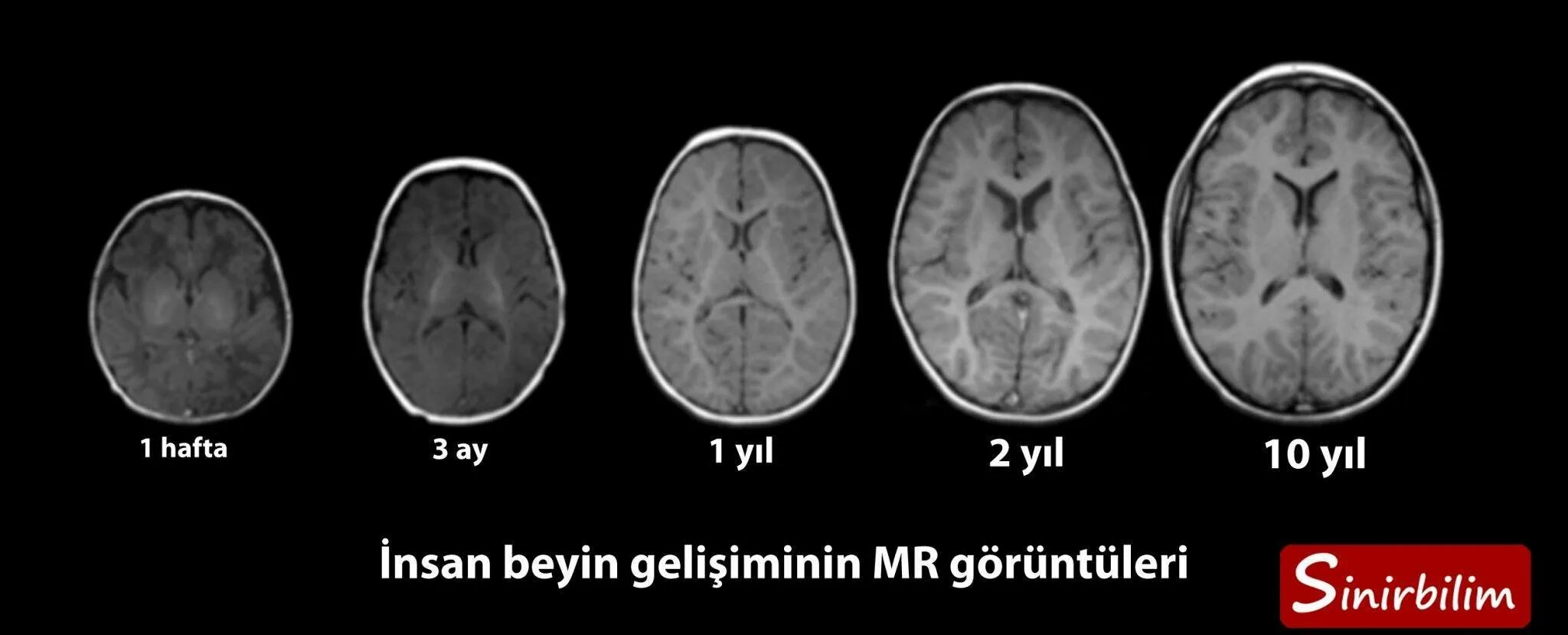 Изменения головного мозга у новорожденного. Кт головного мозга новорожденного норма. Мозг ребенка норма мрт. MRT головного мозга Norma. Кт головного мозга норма.