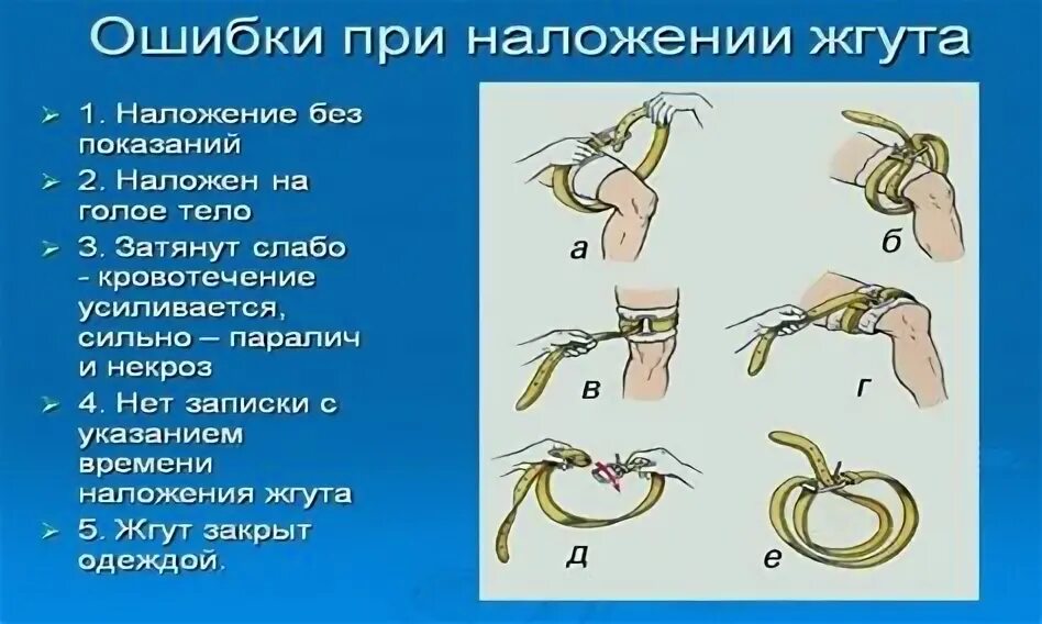Технику наложения жгута на конечности. Наложение жгута при артериальном кровотечении. Наложение жгута при артериальном и венозном кровотечении. Как наложить жгут при артериальном кровотечении. Признаки неправильного наложения артериального жгута.