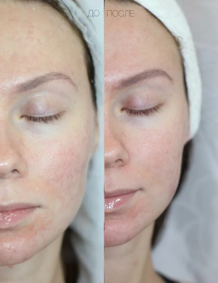 Azelaic Acid in Skin Care: How It Works, Best Products and Use Chemical skin pee