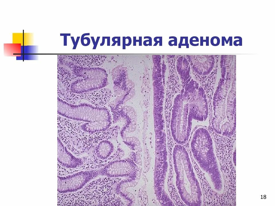 Тубулярная аденома толстой. Тубулярная аденома желудка гистология. Тубулярно трабекулярная аденома.