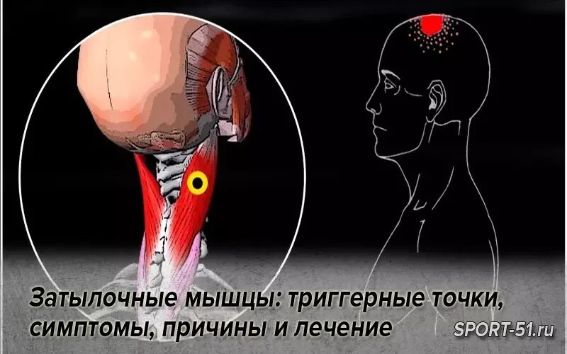 Нейропатия затылочного. Затылочные мышцы. Триггерные точки затылочных мышц. Триггерные точки при невралгии затылочного нерва.