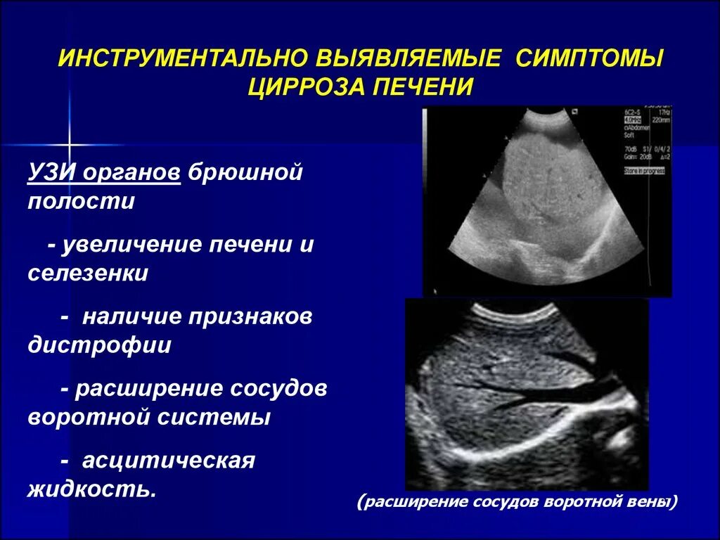 Патология селезенки. Цирроз печени критерии УЗИ. Узлы регенерации печени при циррозе на УЗИ. УЗИ признаки цирроза печени. Ультразвуковое исследование при патологии печени.