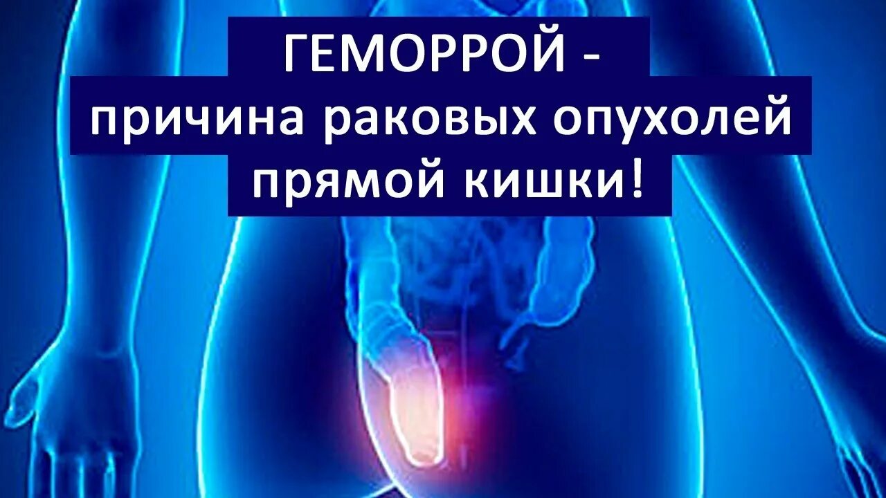 Геморрой - причина раковых опухолей прямой кишки! #геморрой #лечениегеморроя #6 