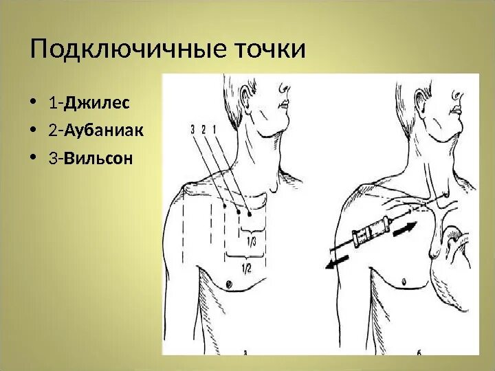 Уход за подключичным катетером. Место пункции подключичной вены. Катетеризация подключичной вены. Методика пункции подключичной вены. Пункция по Сельдингеру подключичной артерии.