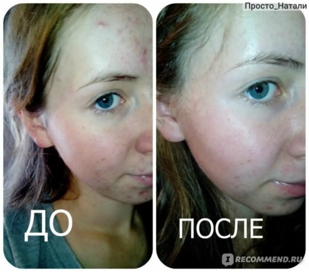 После применения какого то. Коллаген для лица результат. Сотрет изотретиноин. Подкожный клещ — демодек. После применения какого то.