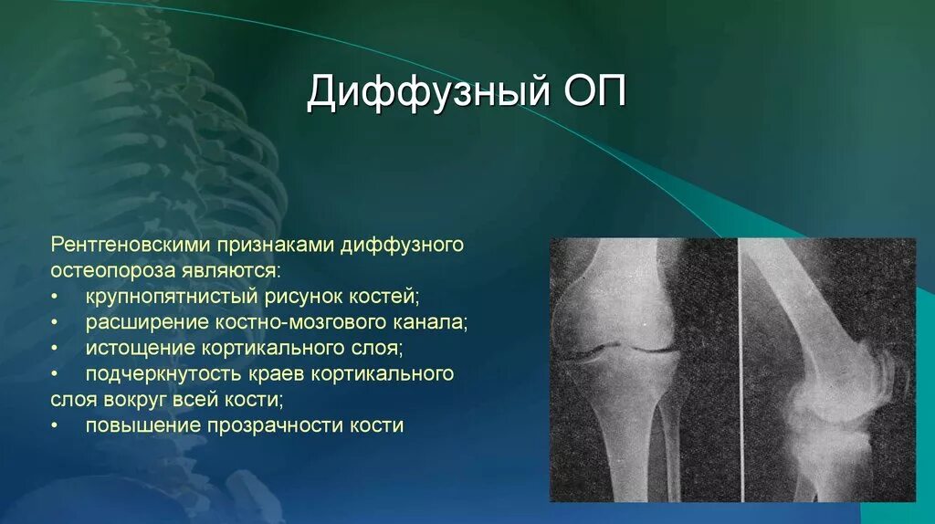 Структурные изменения костей. Рентгенологические признаки диффузного остеопороза. Диффузный остеопороз позвоночника на кт. Остеопороз симптомы рентген. Пятнистый остеопороз рентген.