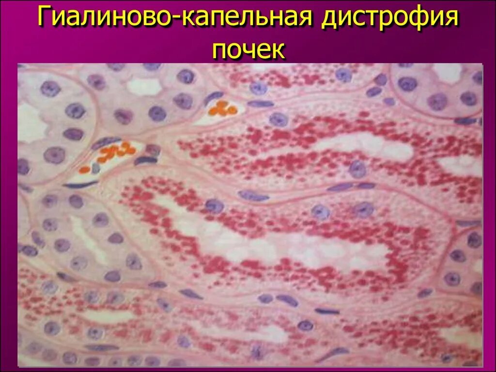 Гиалиново-капельная дистрофия эпителия канальцев почки. Гиалиново капельная дистрофия извитых канальцев почек. Гидропическая дистрофия печени. Гиалиново-капельная дистрофия почек микропрепарат. Гиалиново капельная дистрофия почек.