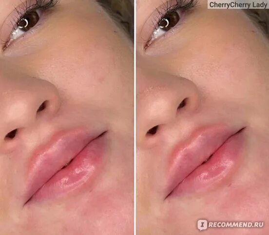 5 мл фото до и после. Гиалуроновая кислота в губы 1 мл. Увеличение губ 2 мл. Коррекция губ гиалуроновой кислотой 1 мл. Зажившие губы 1мл гиалуронка.