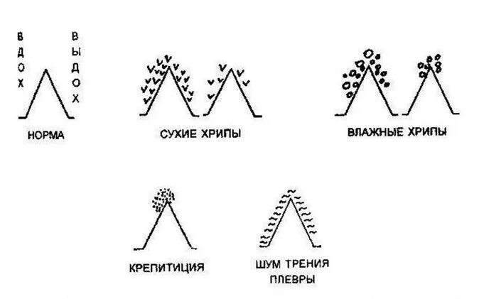 Виды хрипов. Механизм образования сухих и влажных хрипов. Механизмы образования сухих и влажных хрипов схема. Механизм образования сухих хрипов схема. Схемы побочных дыхательных шумов.