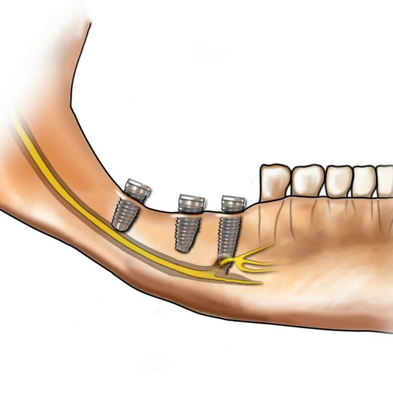 Почему немеют зубы. Нижнечелюстной нерв анатомия. Повреждение нижнечелюстного нерва при имплантации. Нижний альвеолярный нерв. Травма имплантами нижнечелюстного нерва.