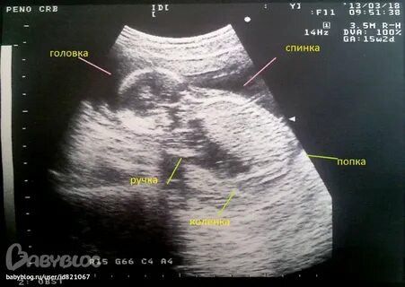 Тонус 11 недель