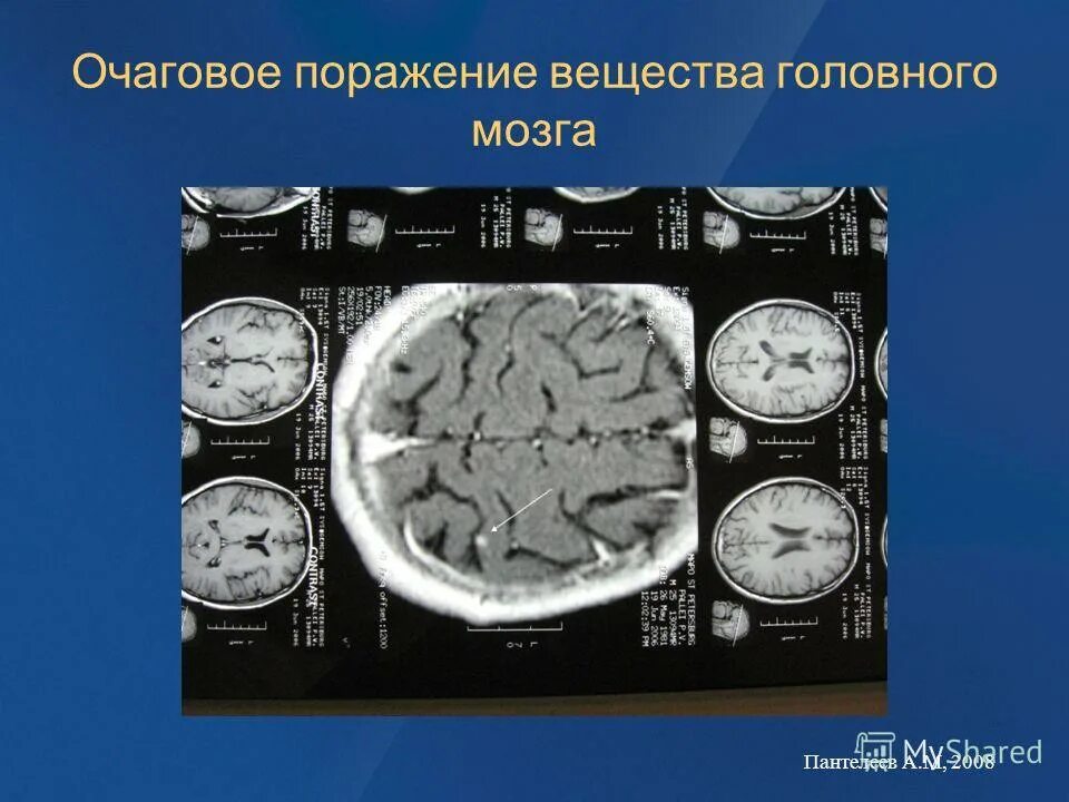 Центральное поражение головного мозга. Очаговые поражения головного мозга. Многоочаговое поражение вещества головного мозга. Симптомы поражения вещества мозга. Поражение головного мозга неуточненное.