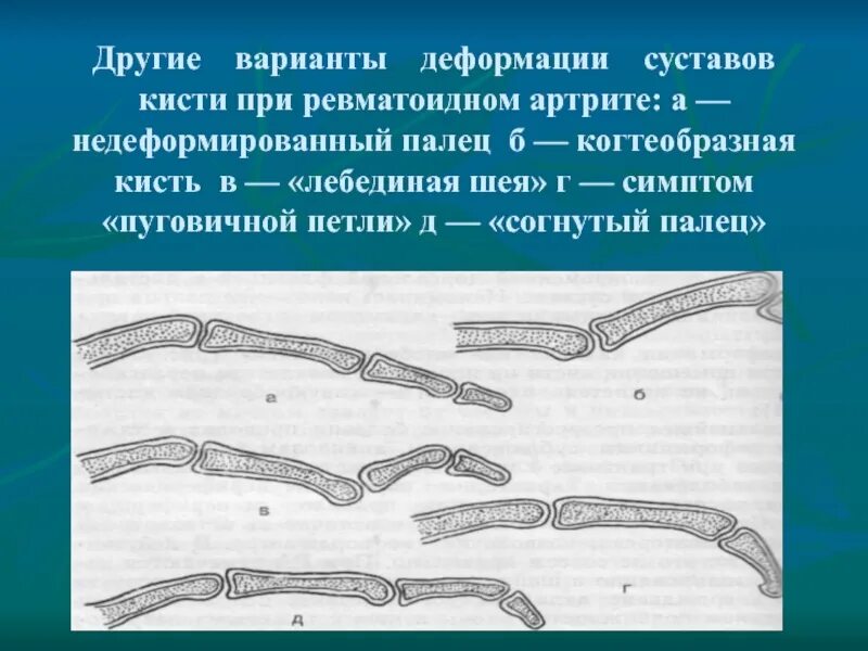 Деформации кисти при артритах. Деформация суставов при ревматоидном артрите. деформация суставов кисти при ревматоидном артрите. деформация кистей при ревматоидном артрите.