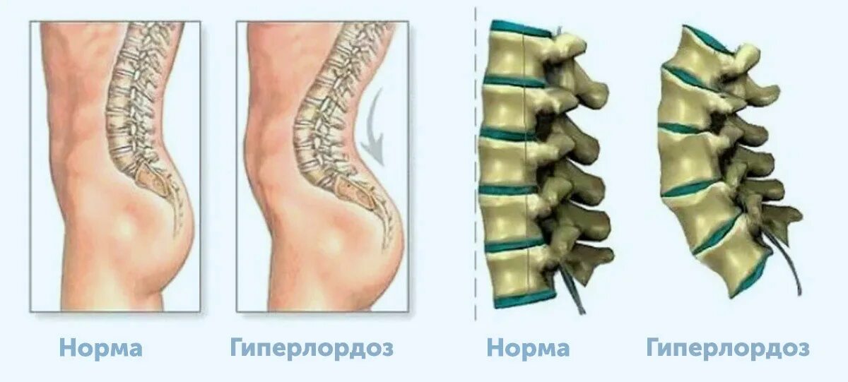 Выгнутая поясница. Лордоз поясничного отдела позвоночника. Гиперлордоз поясничного отдела норма. Лордоз позвоночника симптомы поясничного отдела позвоночника. Гиперлордоз в пояснично-крестцовом отделе позвоночника.