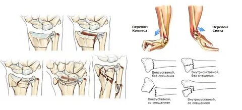 Перелом сустава и лучевой кости