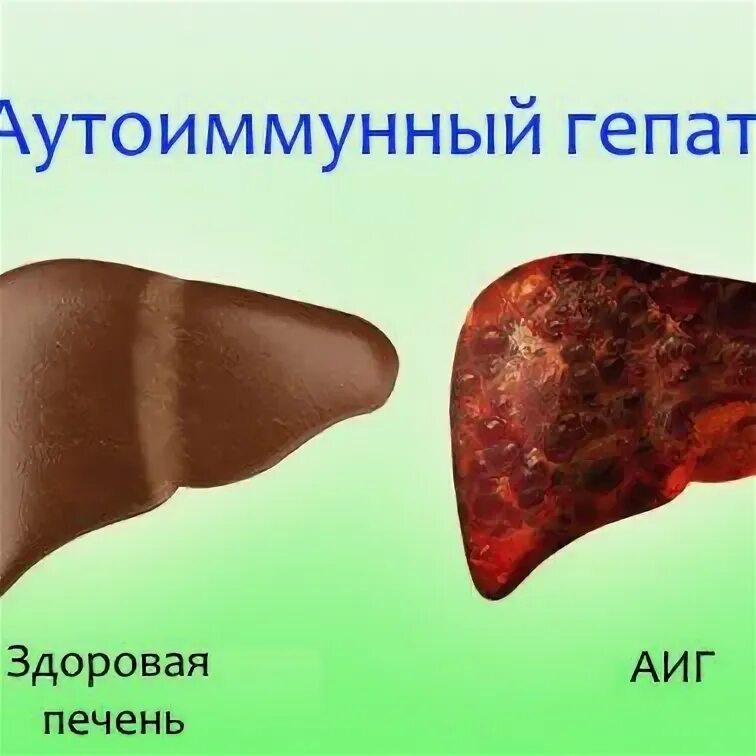 Гепатит с тип 2. Аутоиммунный гепатит 2 типа. токсический гепатит печени фото.