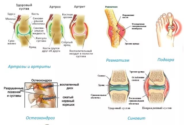 Артрит и артроз разница. Ревматоидный артрит и артроз. Подагра артрит артроз различия. Подагра ревматоидный артрит артроз разница.