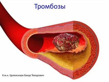 Тромбы в сосудах